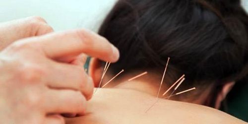 Apakah Akupunktur Alternatif Yang Baik Untuk Syringomyelia? Perawatan chiropractic berfokus pada pemulihan