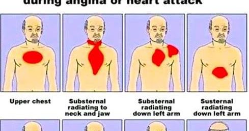 Gejala Serangan Jantung serangan jantung adalah penyebab dari